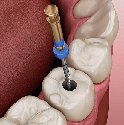 Treatment - Brimington Dental Practice